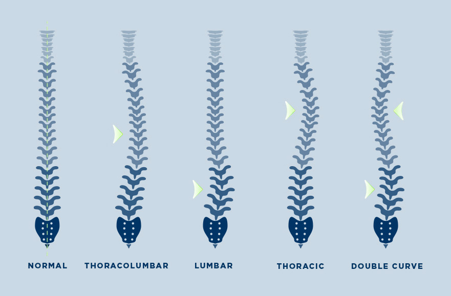 Classification of scoliosis curves: thoracolumbar, lumbar, thoracic and double curve