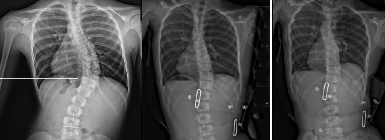 Benjamin's x-rays show his spine straightening over the course of treatment. with the middle and right x-rays showing the in-brace correction achieved with the LOC Scoliosis Brace.