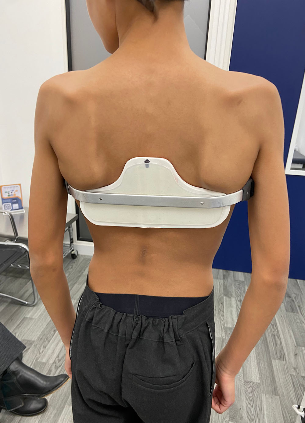 Will's pectus carinatum started to improve within months after starting treatment with the London Orthotic Consultancy and wearing bespoke pectus braces