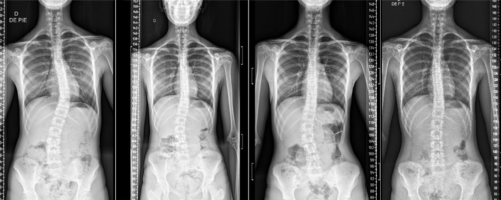 X-rays showing Cobb angle decreasing and spine straightening after a year of wearing the LOC Scoliosis brace