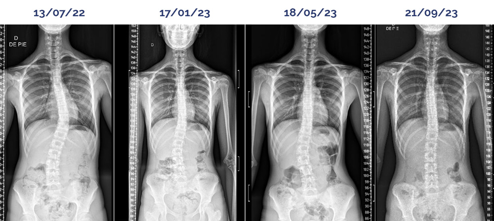 Adolescent Idiopathic Scoliosis patient's x-rays showing the spine straightening over the course of treatment and the Cobb angle reducing in a year and a half