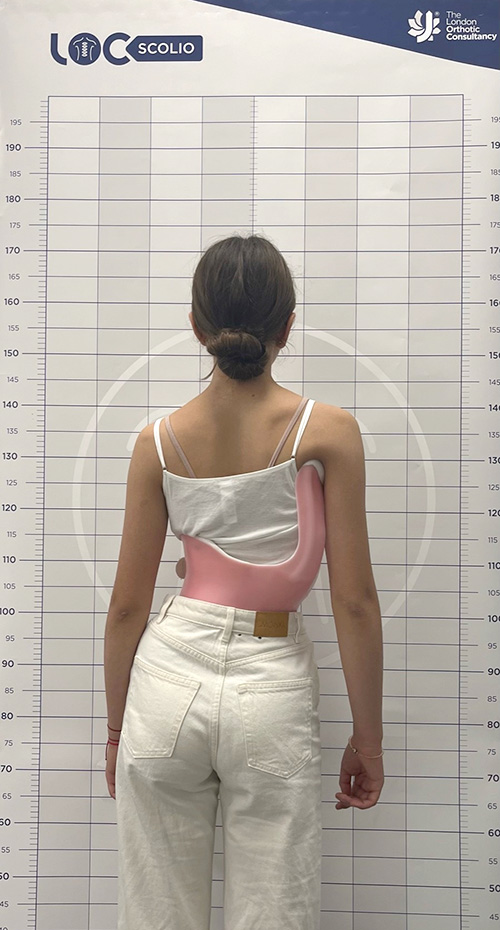 Teenager scoliosis patient wearing a hyper corrective LOC scoliosis brace from the London Orthotic Consultancy