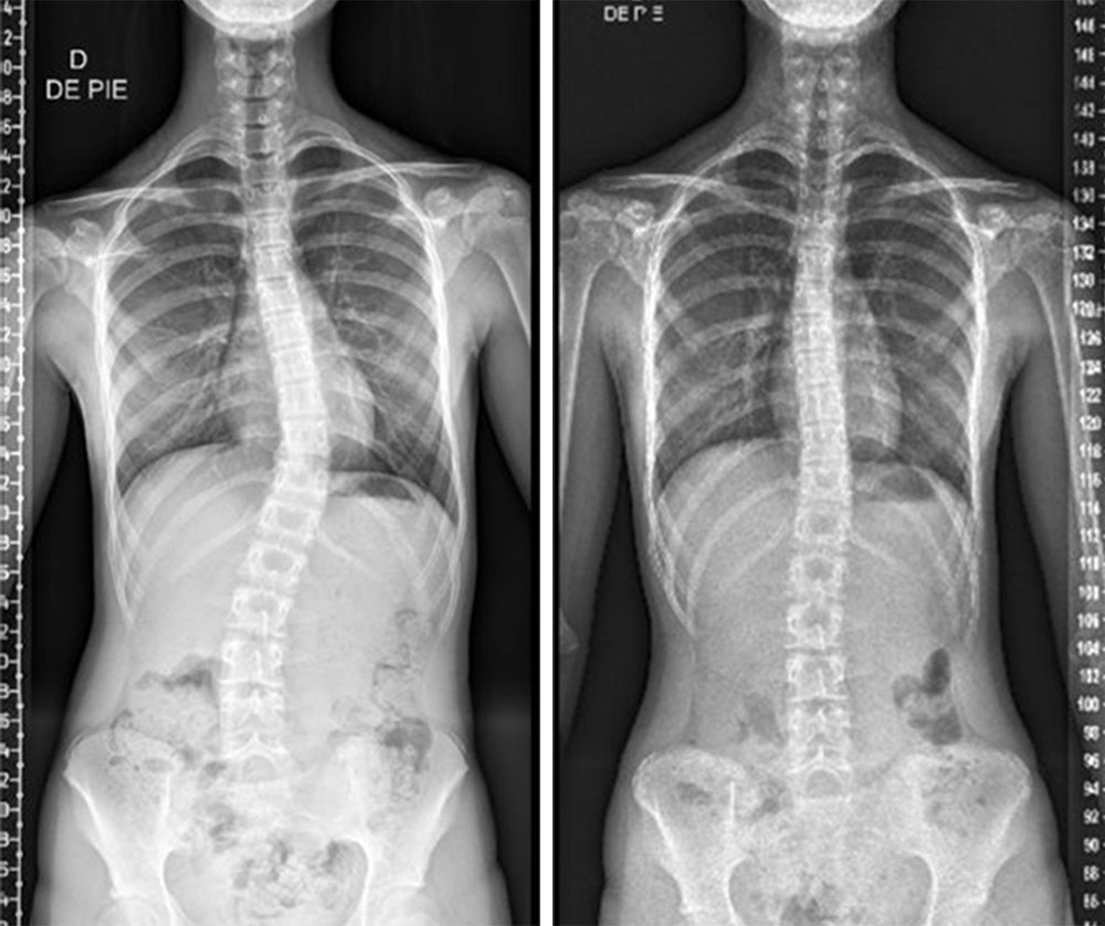 Adolescent Idiopathic Scoliosis Patient x-ray showing Cobb angle reduced from 29 degrees to 14 degrees in just over 1 year of wearing the LOC scoliosis brace
