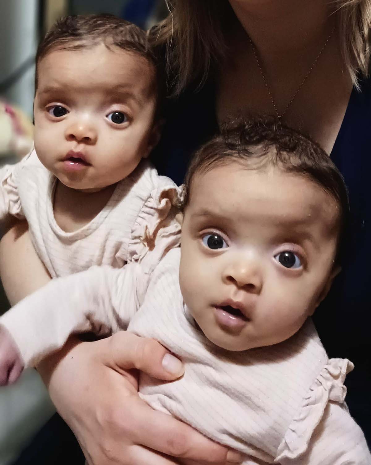 Ella and Nina identical twins with craniosynostosis
