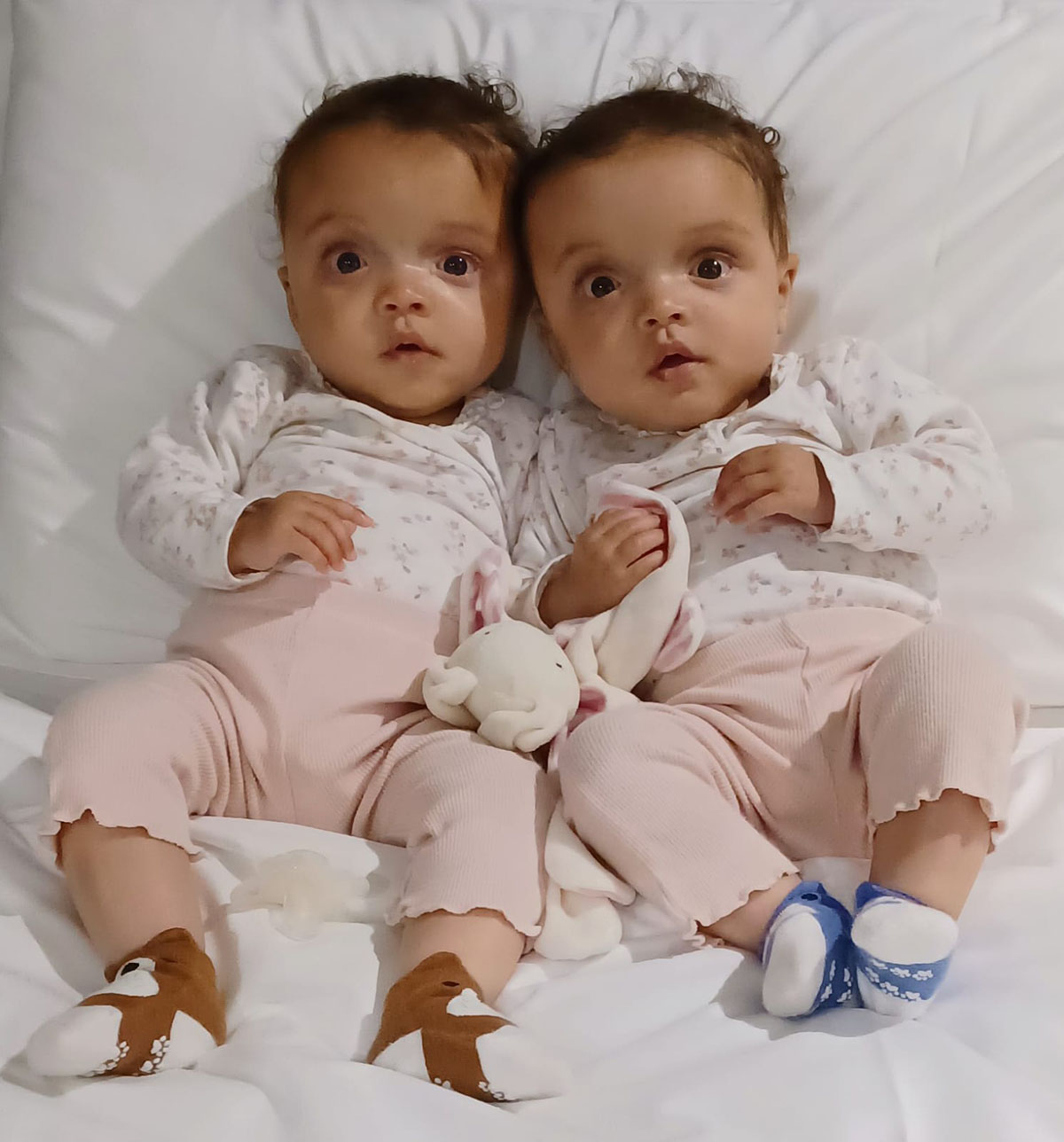 Twins Ella and Nina who were diagnosed with craniosynostosis at six months old
