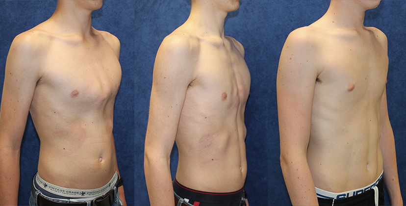 Chest shape results before and after pectus carinatum bracing treatment