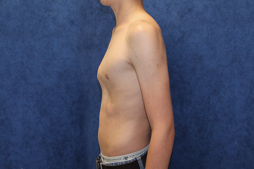 Teenage boy with chest bone sticking outward from pectus carinatum