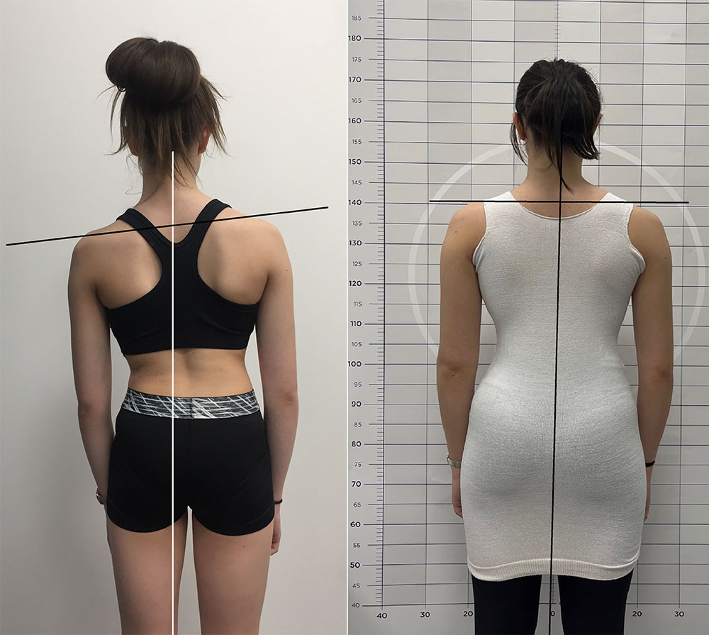 Side-by-side comparison of a scoliosis patient before and after bracing treatment, showing improved spinal alignment