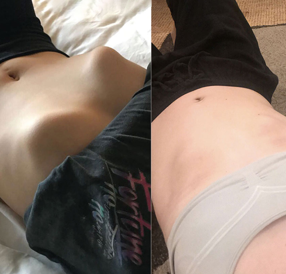 Teenage girl with ribs sticking out showing before and after results of treatment