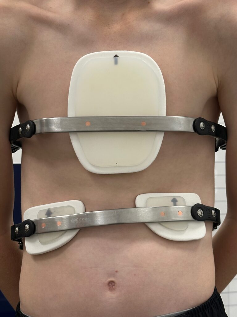 Ethan’s Pectus Carinatum Journey | Non-Surgical Bracing Success
