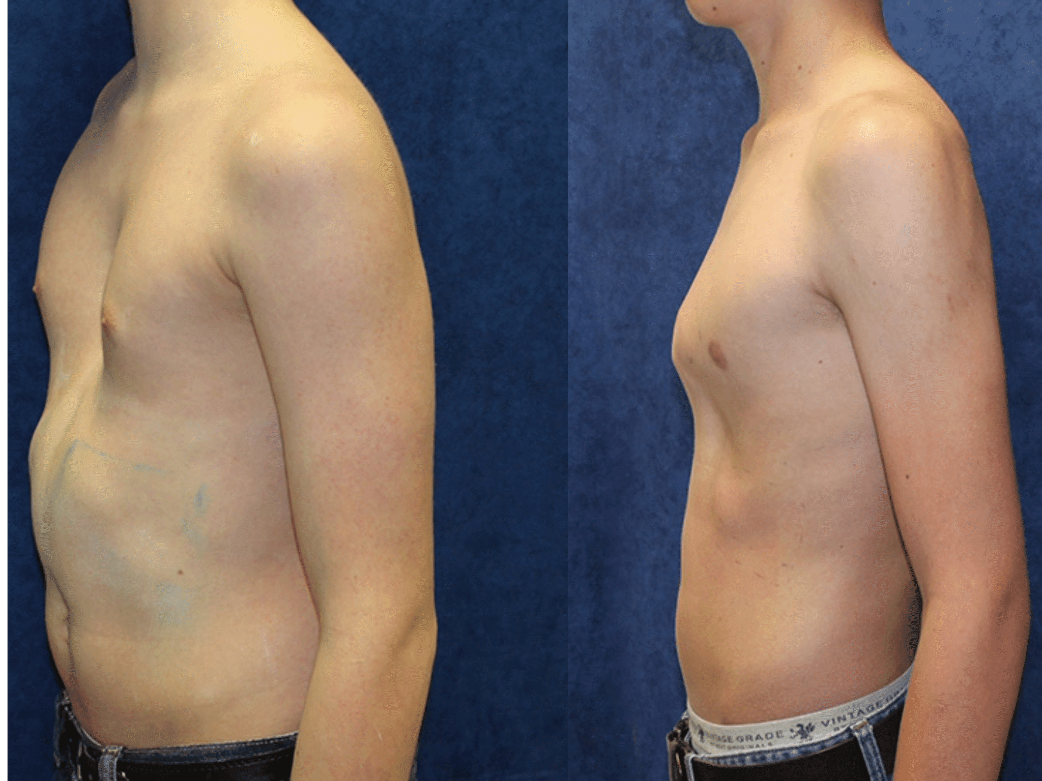 Pectus Excavatum Vs Carinatum Key Differences Treatment Options